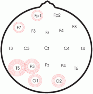 leerprobleem Leerproblemen Neurofeedback